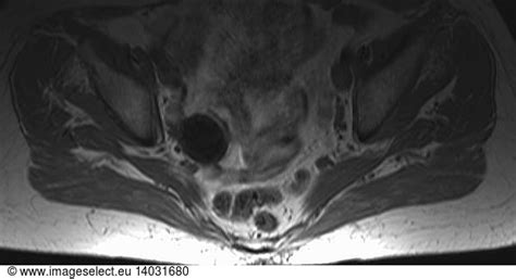 Ovarian cyst Ovarian cyst, MRI,3cm,81,abnormal - Rights Managed ...