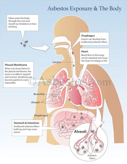 Mesothelioma And Asbestos Images Diagrams And Graphs