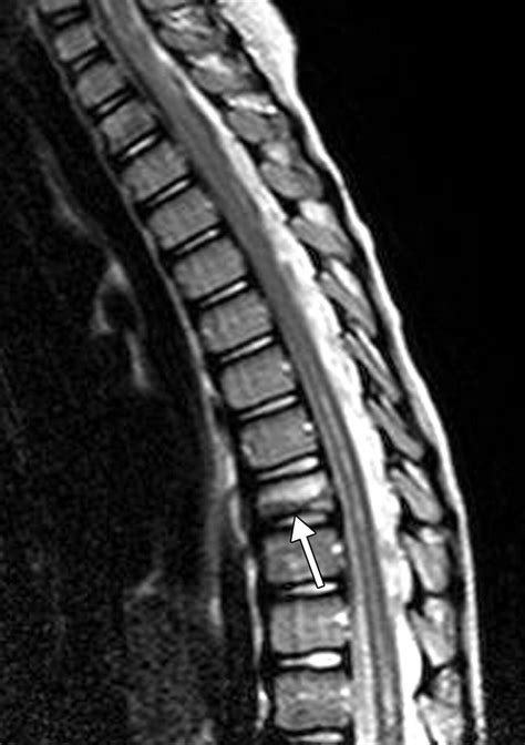 Imaging Of Chronic Recurrent Multifocal Osteomyelitis Radiographics