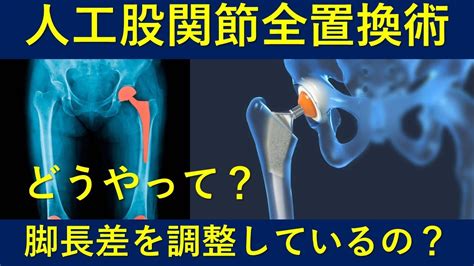 人工股関節全置換術total Hip Arthroplastyの脚長差はどうやって調整しているの？ Youtube