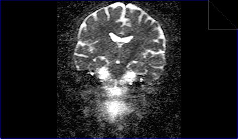 Cholesteatoma Mri Radiology Article On Cholesteatoma