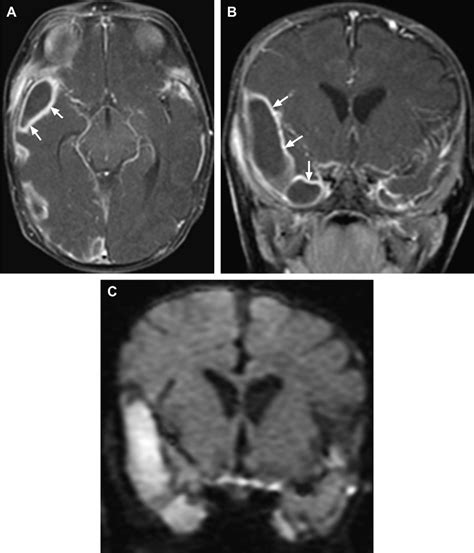 Subdural Empyema Axial A And Coronal B Contrast Enhanced