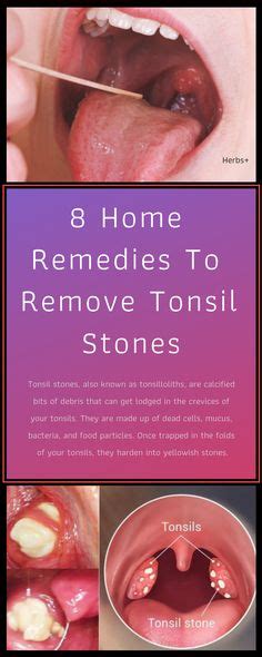 Tonsil Stones