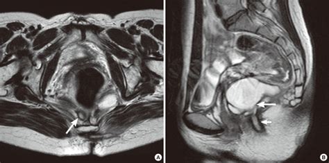 Pilonidal Cyst Mri