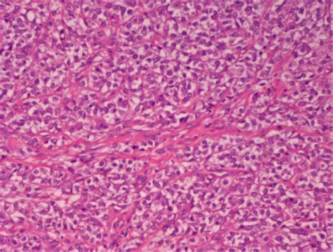 Clear Cell Sarcoma Nests Of Epithelioid Cells With Eosinophilic Or