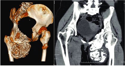 Three-dimensional reconstruction of the patient's computed tomography ... 
