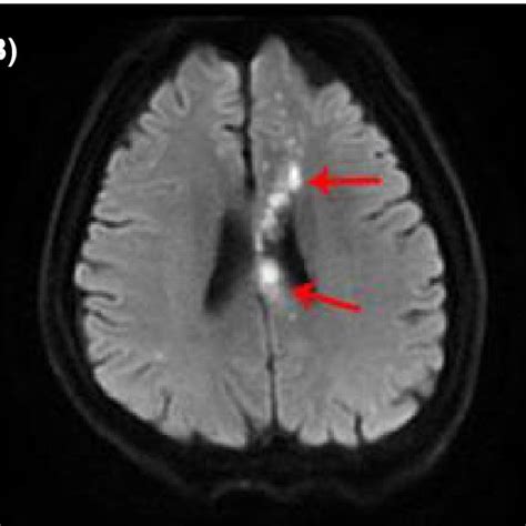 MRI images showing acute cerebral infarction in multiple sites of the ...