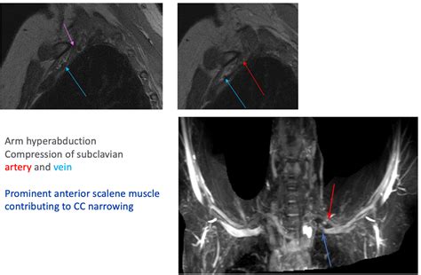 Thoracic Outlet Syndrome X Ray