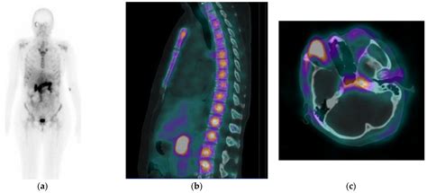 Cancers Free Full Text 99mtc Tc Db15 In Grpr Targeted Tumor