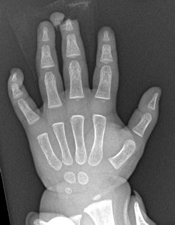 Traumatic Finger Amputation Radiology Case Radiopaedia Org