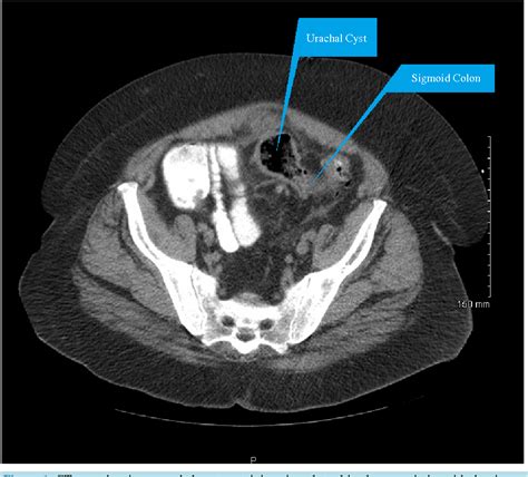 Figure 1 From Laparoscopic Resection Of A Urachal Sigmoid Fistula In A