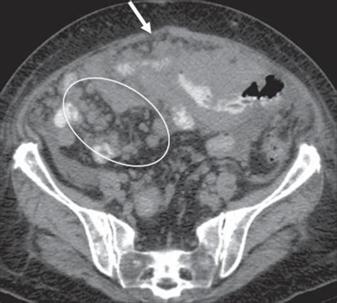 Scielo Brasil Abdominal Manifestations Of Extranodal Lymphoma Pictorial Essay Abdominal