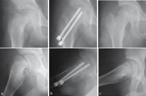 Case Acute Slipped Capital Femoral Epiphysis Scfe In A Year Old