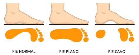 Pies Planos En El Niño ¿cómo Evoluciona El Pie En Esta Etapa De Crecimiento Consultas