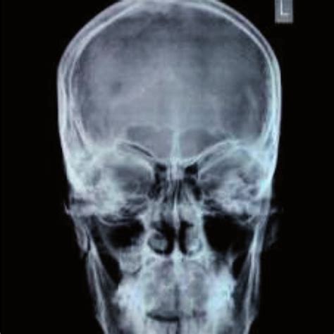 Posterior anterior skull view. | Download Scientific Diagram