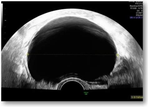 Diagnostics Free Full Text An Unusual Case Of Urachal Cyst