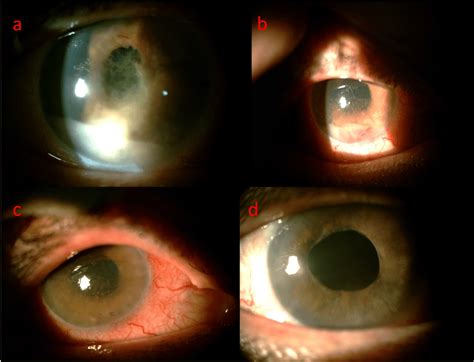 Slit photography of the right eye; hypopyon anterior uveitis with ...