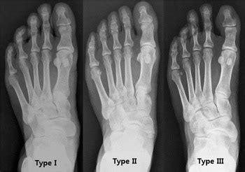 Genetic Influence on Accessory Navicular Bone in the Foot: A Korean ...