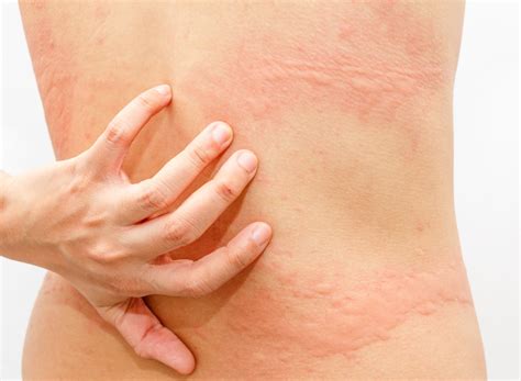 What Is Urticaria Reflab Aps