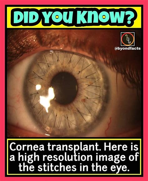 Cornea Transplant Here Is A High Resolution Image Of The Stitches In