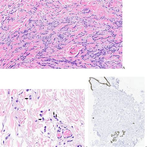 A A Histologic Section Of Skin Punch Biopsy At Intermediate Power