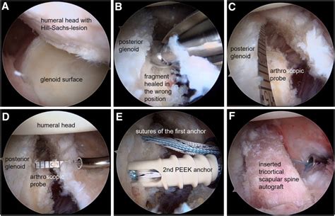 Arthroscopic Posterior Bone Block Stabilization Using A Tricortical