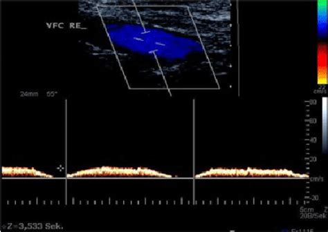 Colour Flow Doppler And Pulsed Doppler Spectral Waveform At The Right