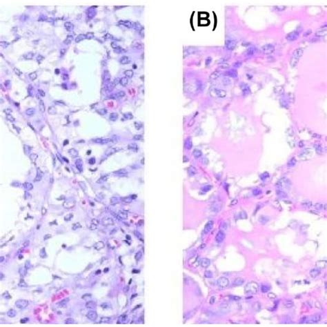 Microscopic Images Showing Histological Details Two Ptcs A C Ptc