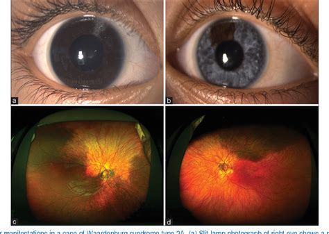 Figure 2 From Bilateral Asymmetrical Partial Heterochromia Of Iris And Fundus In Waardenburg