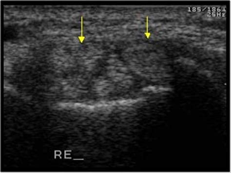 Musculoskeletal Joints and Tendons | 6.3 Wrist and carpus : Case 6.3.2 Tenosynovitis of the ...