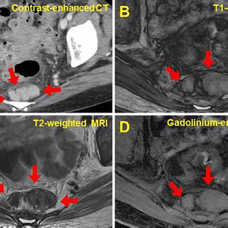 Figure Computed Tomography Guided Biopsy Of The Presacral