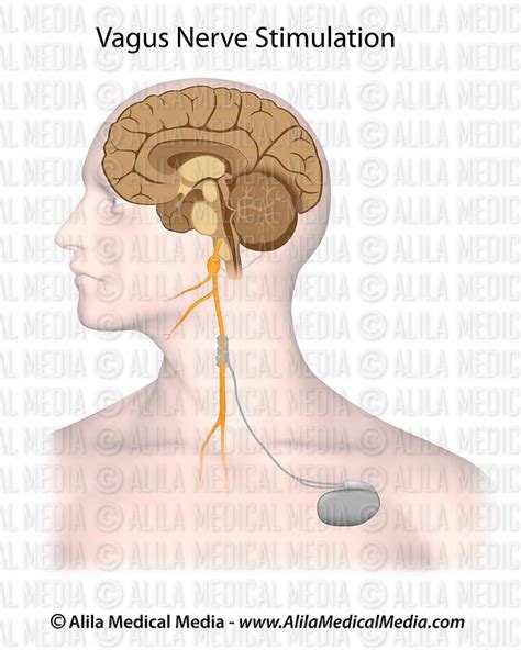 Alila Medical Media Vagus Nerve Stimulation Therapy Medical Illustration