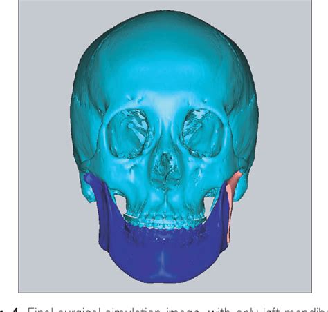 Figure From Unilateral Intraoral Vertical Ramus Osteotomy Based On