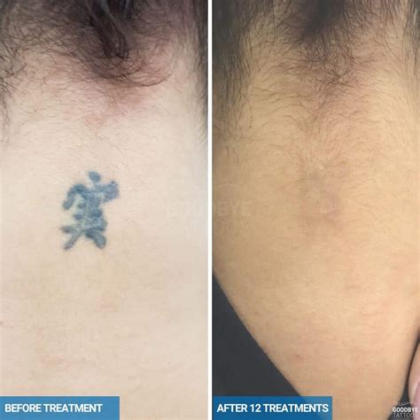 Tattoo Removal Before And After Dark Skin