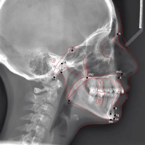 A Skeletal Angular Measurements 1 Sna 2 Snb 3 Anb 4 Snd Download Scientific