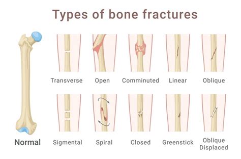 thousand bone fractures humans royalty  images stock