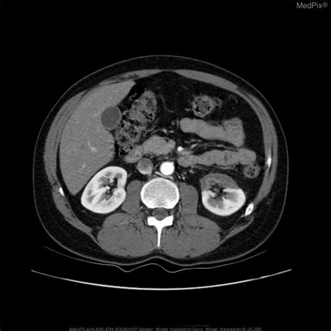 Pale Infarct Kidney