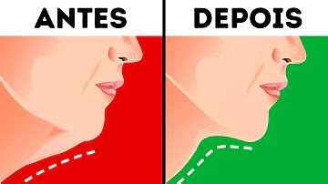 O Que Pode Ser Um Caroço Embaixo Do Queixo - O que pode ser um caroço embaixo do queixo?