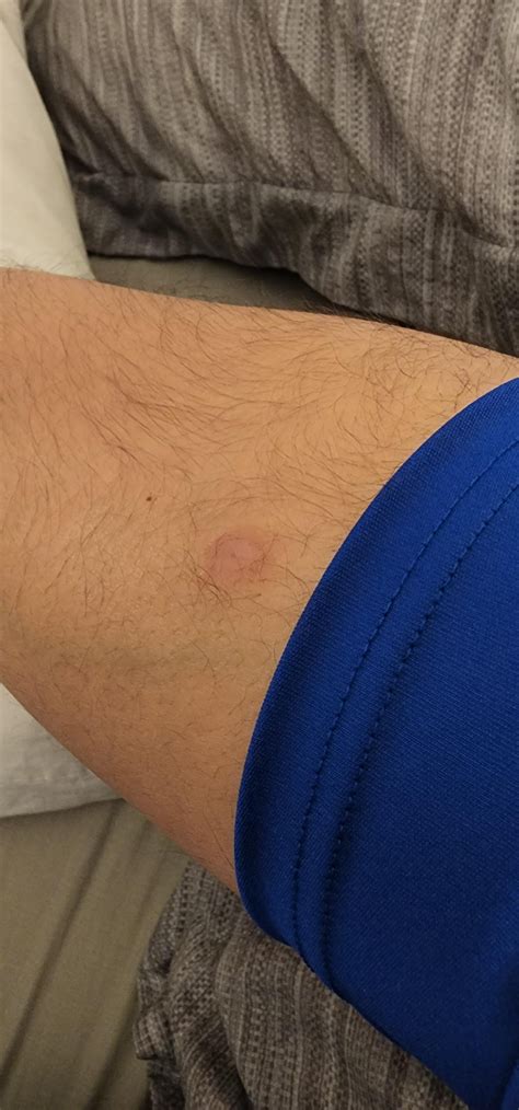 does clinda cover mrsa 7