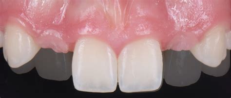 Three Solutions For Congenitally Missing Lateral Incisors Spear Education