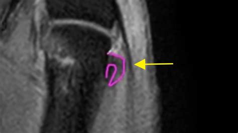 Thumb Mri Stener Like Lesion Of The Radial Collateral Ligament Youtube