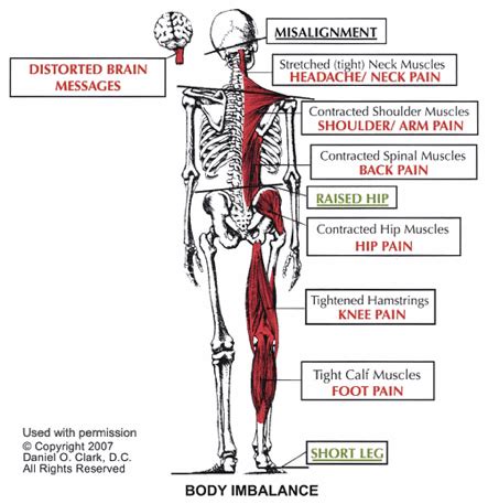 Scoliosis And The Upper Cervical Spine Jarek Esarco D C