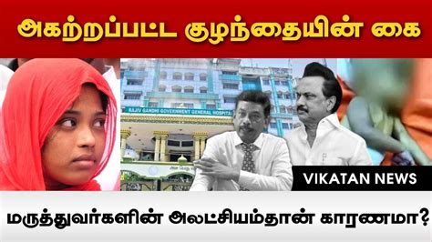 அகற்றப்பட்ட குழந்தையின் கை மருத்துவர்களின் அலட்சியம்தான் காரணமா