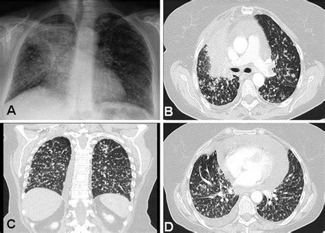 Chest X Ray Miliary Tb