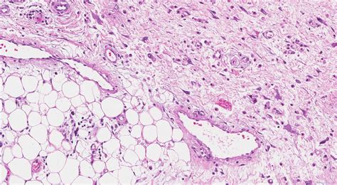 Dedifferentiated Liposarcoma Ottawa Atlas Of Pathology