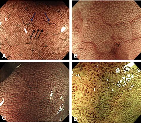 Figure 1 From Gastric Mucosal Pattern By Using Magnifying Narrow Band Imaging Endoscopy Clearly