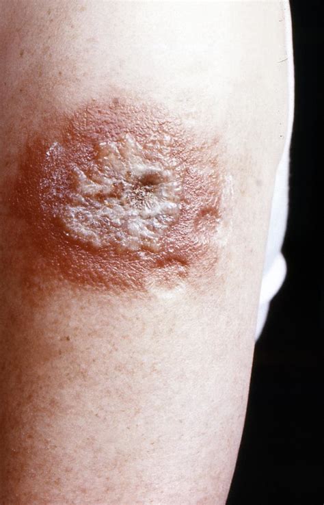 Smallpox physical examination - wikidoc