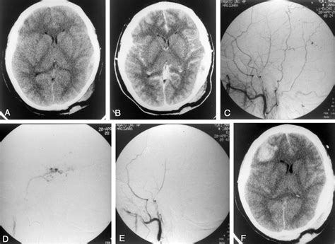 Case 7. A, CT scan demonstrates an epidural hematoma on the left side... | Download Scientific ...