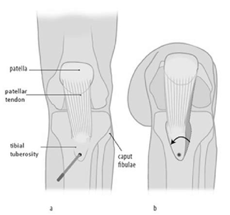 Prominent Tibial Tuberosity