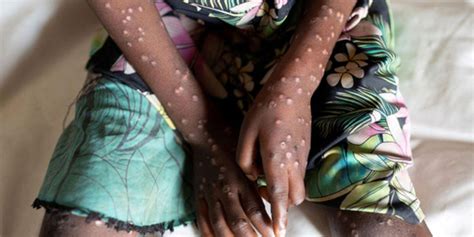 Africa Cdc Likely To Declare Mpox Public Health Emergency Next Week